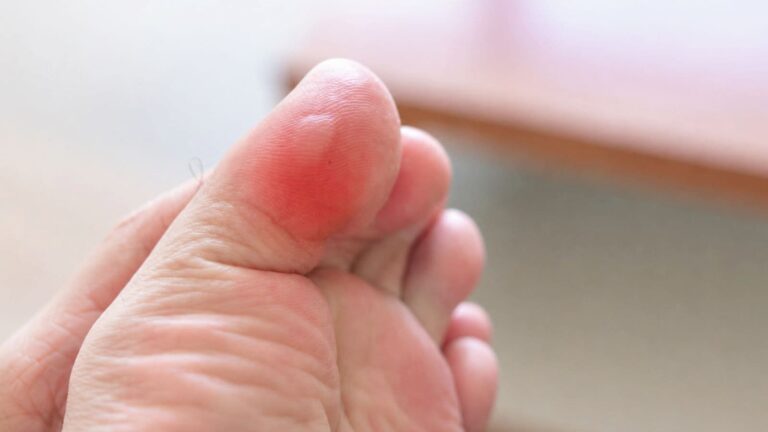 trail runner checking running shoe after developing blister from technical trail conditions